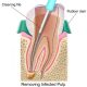 Blausen_0774_RootCanal